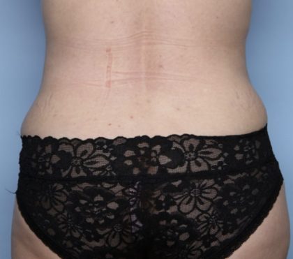 Tummy Tuck Before & After Patient #32411