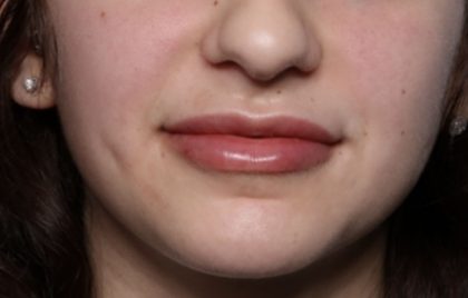 Lip Filler Before & After Patient #32435