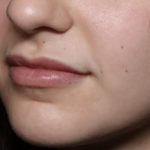 Lip Filler Before & After Patient #32435