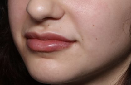 Lip Filler Before & After Patient #32435