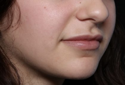 Lip Filler Before & After Patient #32435