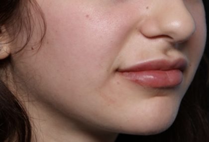 Lip Filler Before & After Patient #32435