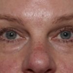 Blepharoplasty Before & After Patient #32442