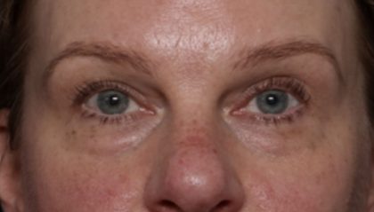 Blepharoplasty Before & After Patient #32442