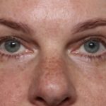 Blepharoplasty Before & After Patient #32442