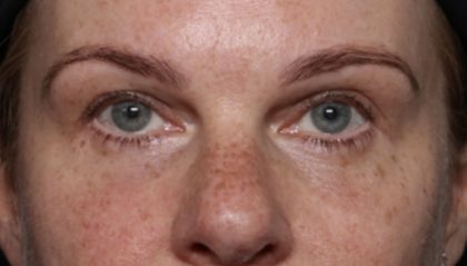 Blepharoplasty Before & After Patient #32442