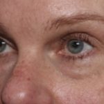 Blepharoplasty Before & After Patient #32442