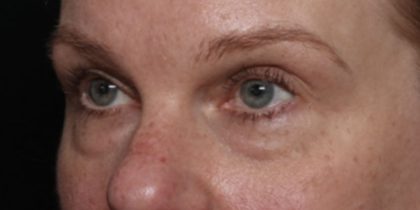 Blepharoplasty Before & After Patient #32442