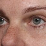 Blepharoplasty Before & After Patient #32442