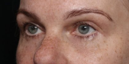 Blepharoplasty Before & After Patient #32442