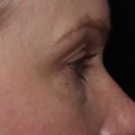 Blepharoplasty Before & After Patient #32442