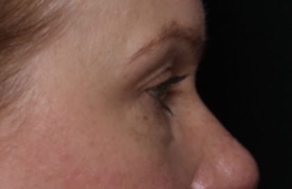 Blepharoplasty Before & After Patient #32442