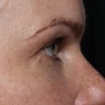 Blepharoplasty Before & After Patient #32442