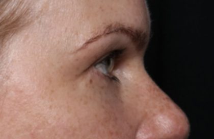 Blepharoplasty Before & After Patient #32442