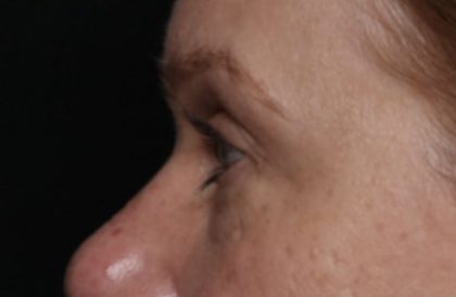 Blepharoplasty Before & After Patient #32442