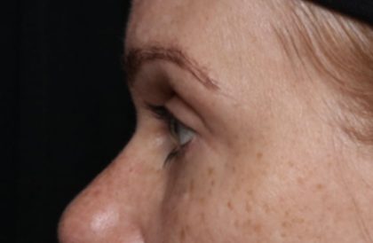 Blepharoplasty Before & After Patient #32442