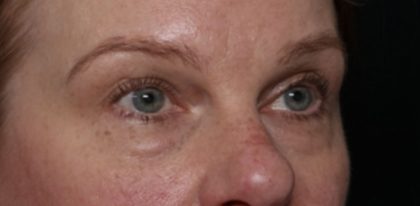 Blepharoplasty Before & After Patient #32442