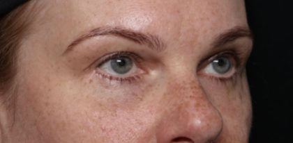 Blepharoplasty Before & After Patient #32442