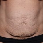 Tummy Tuck Before & After Patient #32453