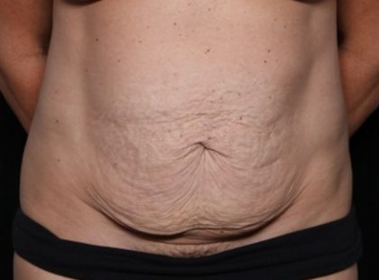 Tummy Tuck Before & After Patient #32453