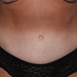 Tummy Tuck Before & After Patient #32453