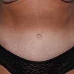 Tummy Tuck Before & After Patient #32453