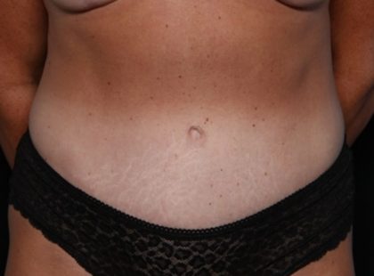 Tummy Tuck Before & After Patient #32453