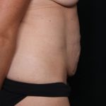 Tummy Tuck Before & After Patient #32453