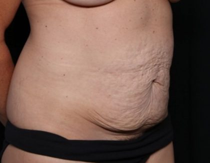 Tummy Tuck Before & After Patient #32453