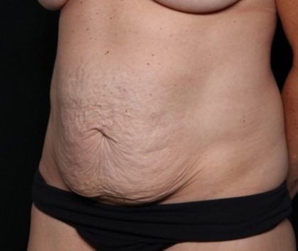 Tummy Tuck Before & After Patient #32453