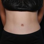 Tummy Tuck Before & After Patient #32464