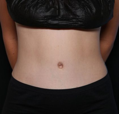 Tummy Tuck Before & After Patient #32464