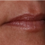 Lip Filler Before & After Patient #32497