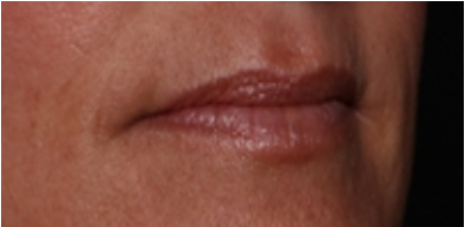 Lip Filler Before & After Patient #32497