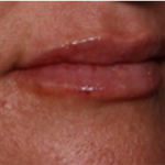Lip Filler Before & After Patient #32497