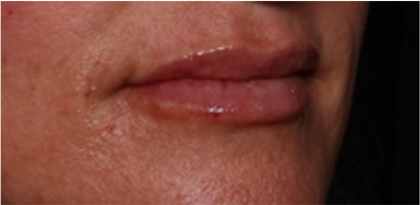 Lip Filler Before & After Patient #32497