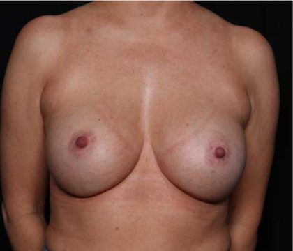 Breast Augmentation - Round Silicone Implants Before & After Patient #32503