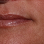 Lip Filler Before & After Patient #32497