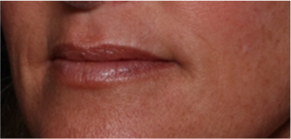 Lip Filler Before & After Patient #32497