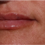 Lip Filler Before & After Patient #32497