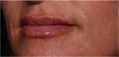 Lip Filler Before & After Patient #32497