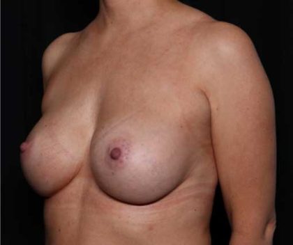 Breast Augmentation - Round Silicone Implants Before & After Patient #32503