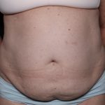 Liposuction Before & After Patient #32526