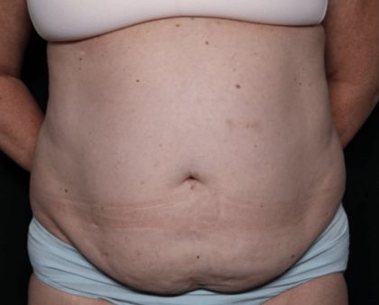 Liposuction Before & After Patient #32526