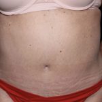 Liposuction Before & After Patient #32526