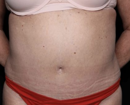 Liposuction Before & After Patient #32526