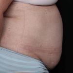 Liposuction Before & After Patient #32526