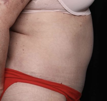 Liposuction Before & After Patient #32526