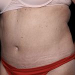 Liposuction Before & After Patient #32526