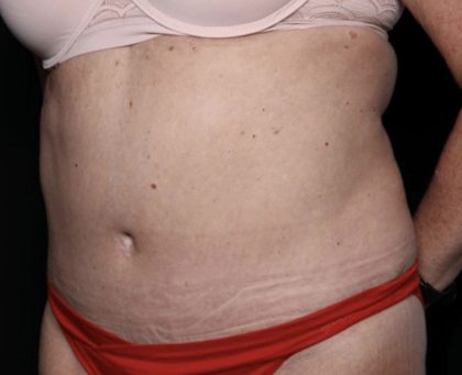 Liposuction Before & After Patient #32526